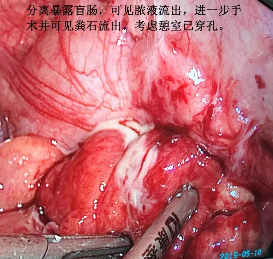 这种病几乎 100% 误诊为阑尾炎，你能否准确识别？