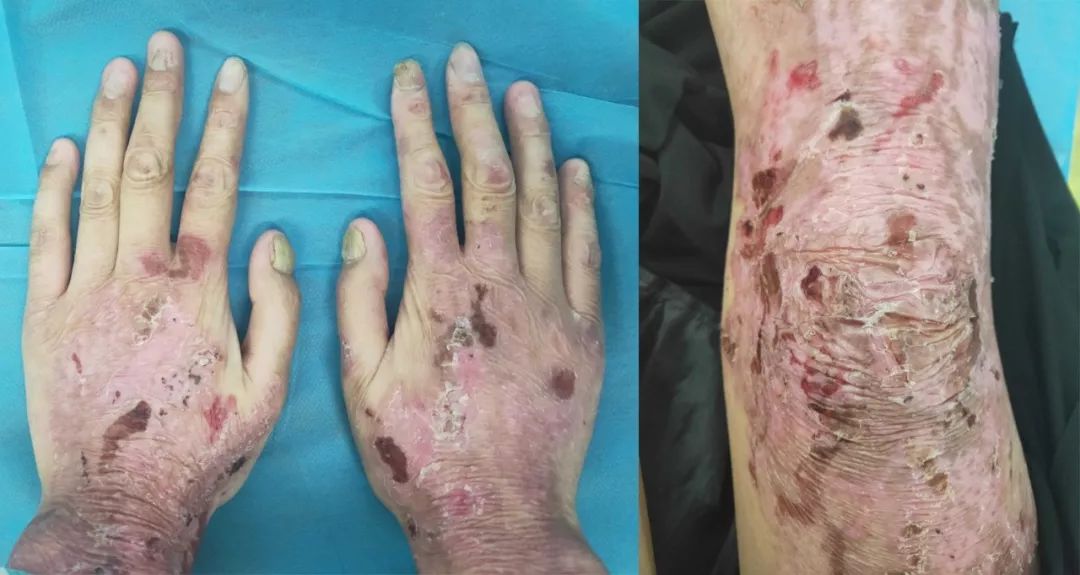 「蝴蝶宝贝」病例分享，人类罕见病中最痛苦的疾病之一