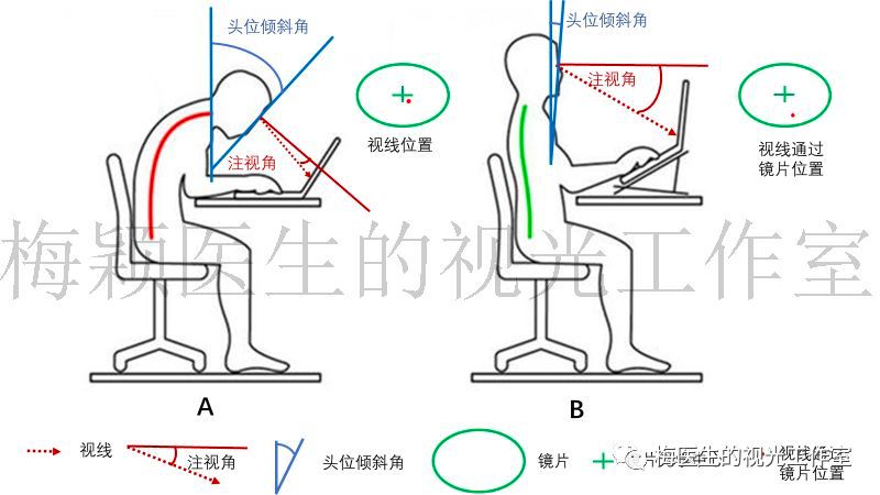 OK 镜可以治疗近视吗？这里有你最关心的 5 个问题