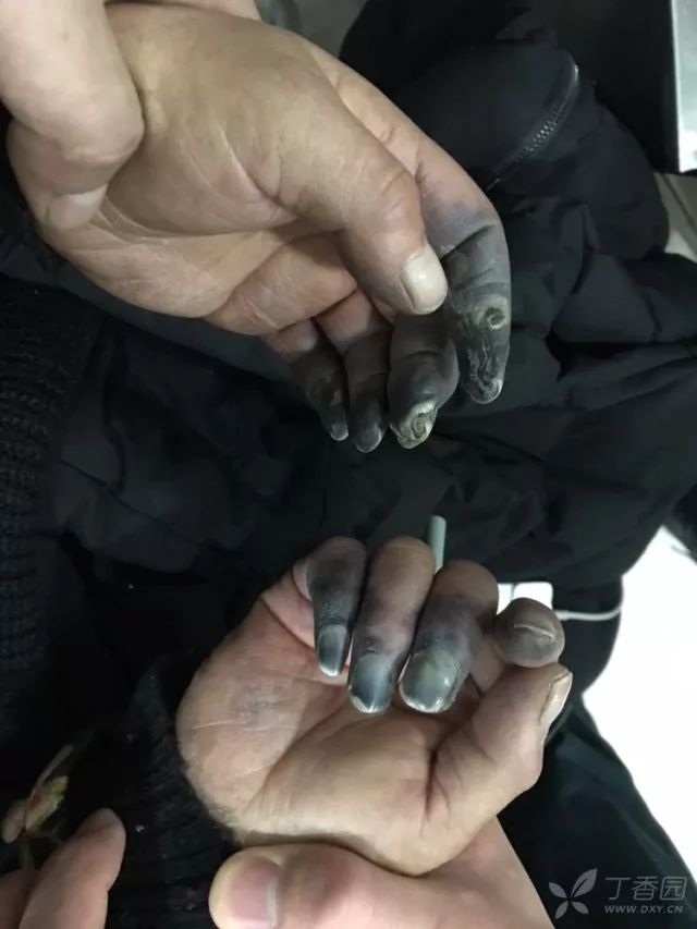 丁香病例 | 三天内手指尖全变黑了，这是什么病？