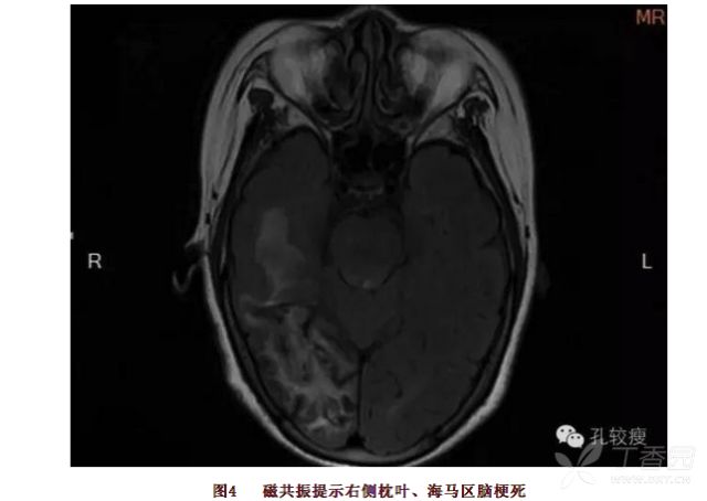 丁香病例 |  反复心梗、反复脑梗、反复消化道出血，这是啥情况？