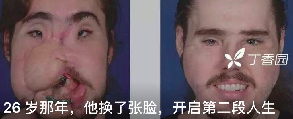 全球首例最完整丁丁移植手术：敏感度高，功能正常