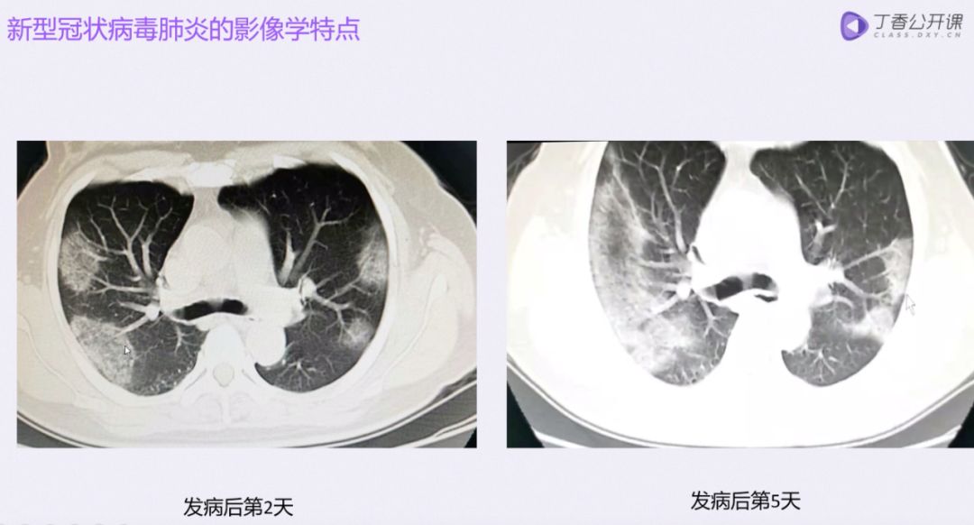 前线速递 | 「新冠肺炎临床诊疗课程」免费上线! 前线速递 | 「新冠肺炎临床诊疗课程」免费上线!