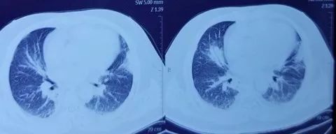 同是重症肺炎，为何 73 岁患者治愈，54 岁患者死亡？