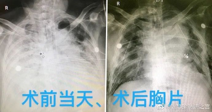 对话陈静瑜：首例新冠肺移植完成后，患者是否存在二次感染风险？