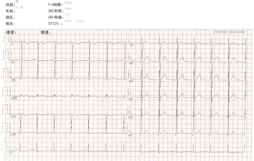 值班遇到「反复胸闷 1 年」,心电图到底怎么看?